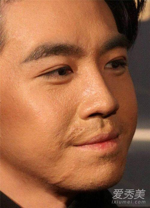 ​俞灏明烧伤后真实素颜照 俞灏明个人资料背景烧伤前后对比